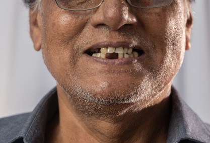 A dentist holding mock dentures in an office room